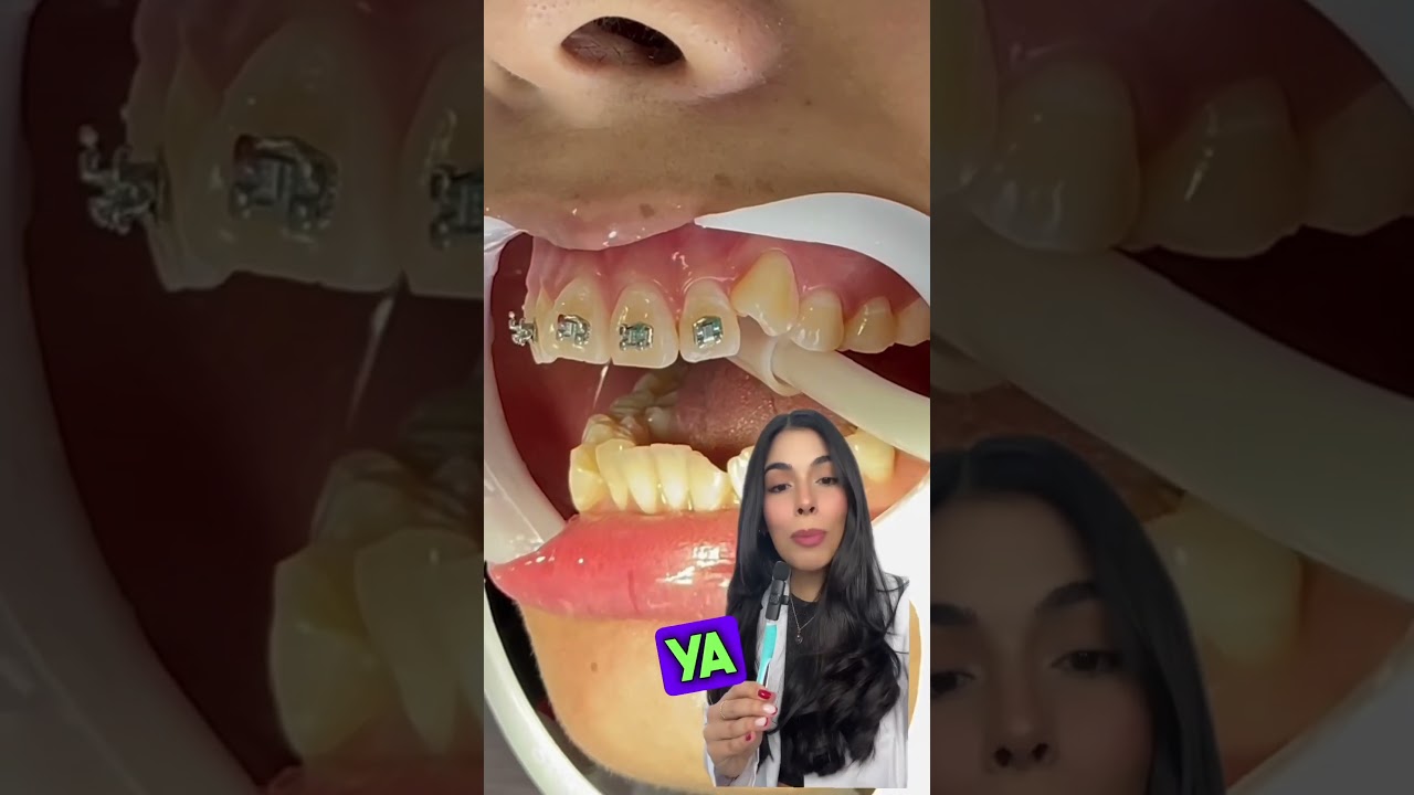 BRACKETS: PASO A PASO DE SU COLOCACI&Oacute;N 😨 #shorts