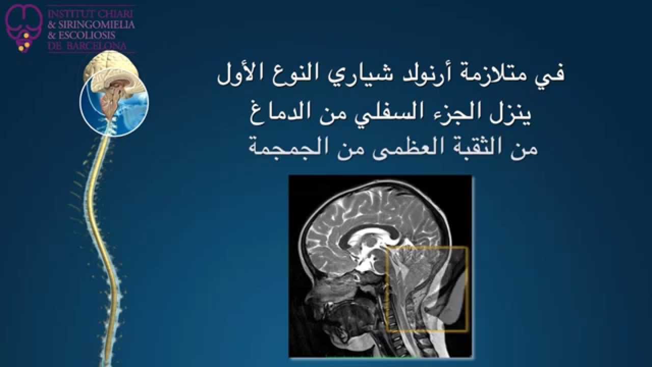 متلازمة أرنولد كياري النوع الأول، تكهف النخاع  و إنحناء العمود الفقري