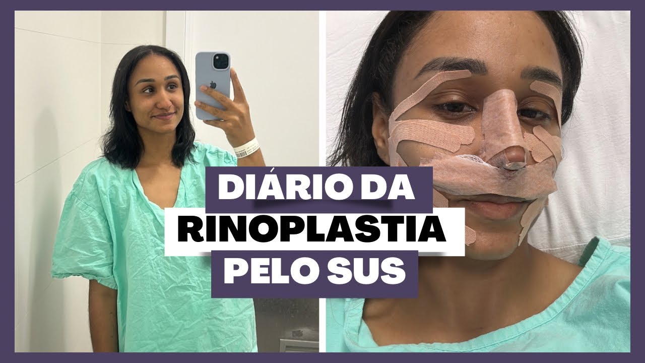 VLOG: Diário da Rinoplastia SUS | 30 dias + Antes e Depois 