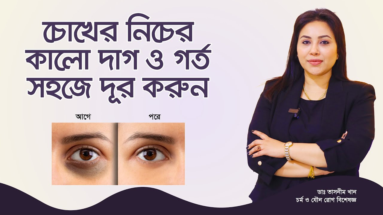 চোখের নিচে কালো দাগ ও গর্ত দূর করার উপায়। Ways to remove dark spots and holes under the eyes.