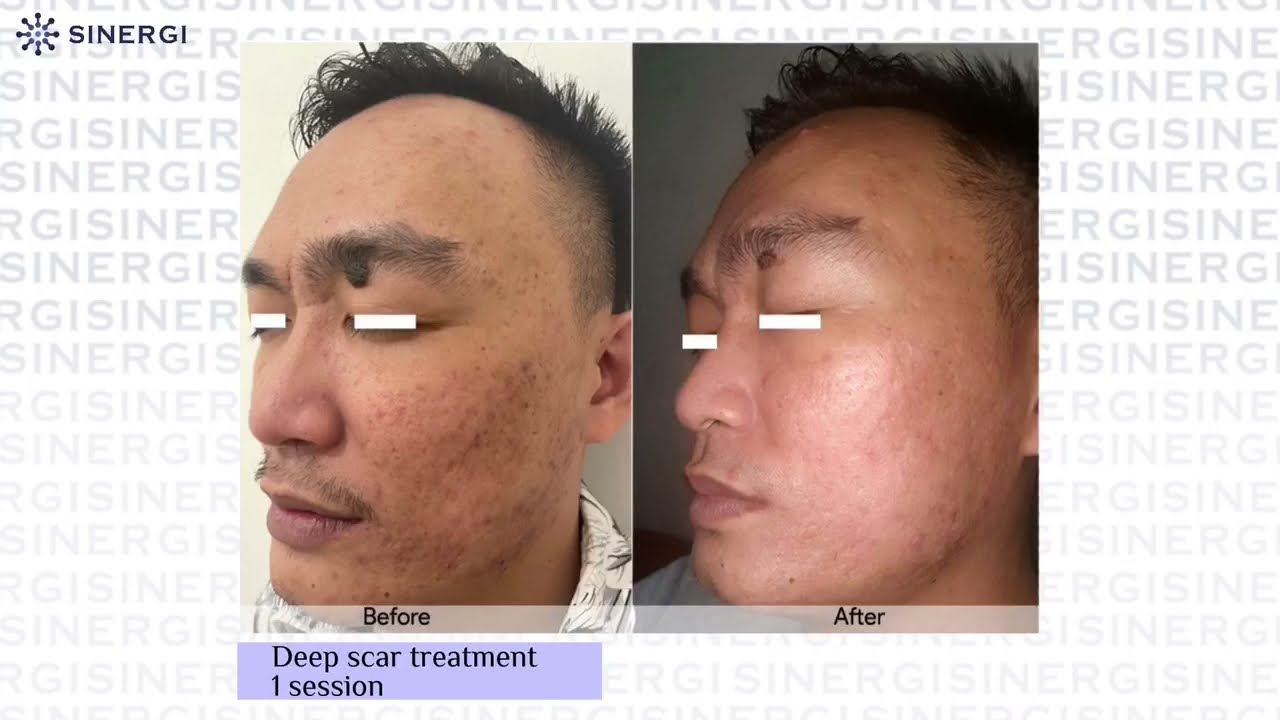 ZENPRO The best Fractional CO2 Laser
