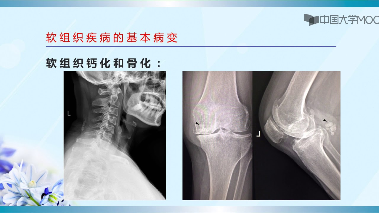 软组织常见疾病影像诊断