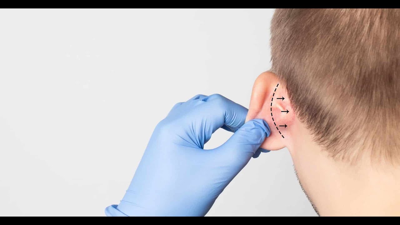 Otoplasty Recovery Day by Day | Ear Surgery Recovery | Lyfboat
