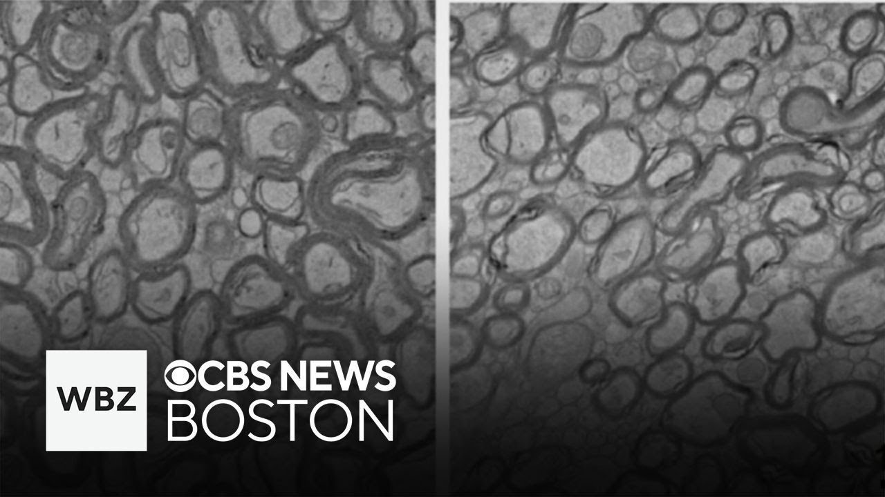 Harvard Medical School Alzheimer's research finds lithium improves memory in mice