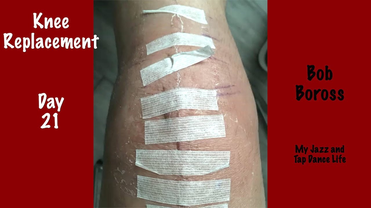 Bob Boross - Knee Replacement - Day 21 Update