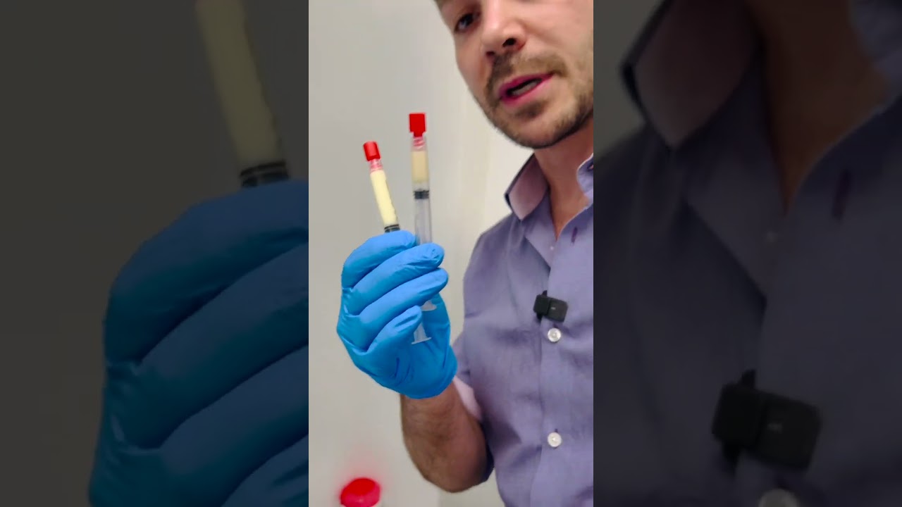 Bio-filler. How to convert PRP into most natural filler for rejuvenating and  re-volumize the face.