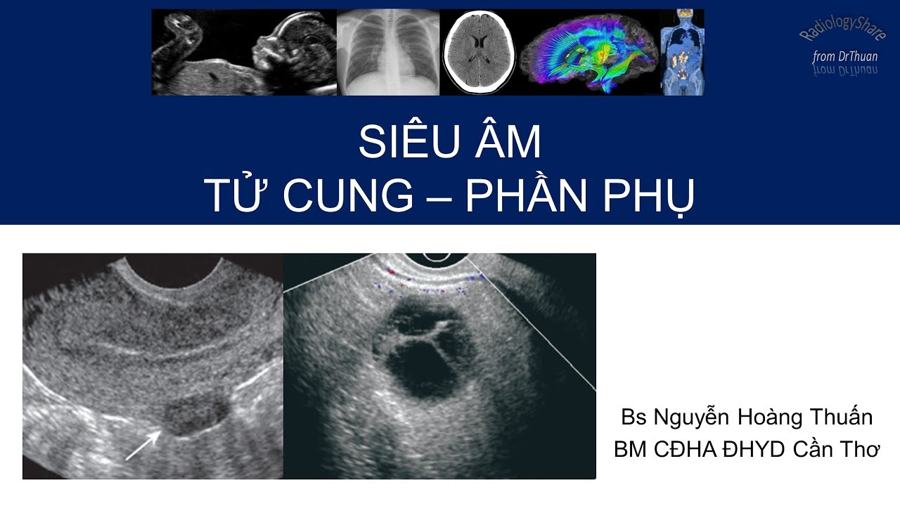 Siêu âm tử cung - phần phụ