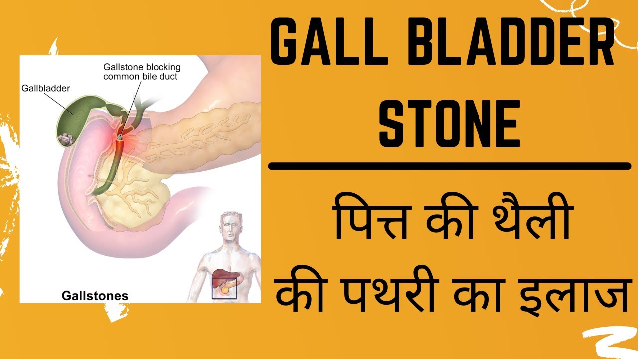 gallbladder stone|gallstone|best homeopathic medicine for galltone|homepathic medicine for gallstone