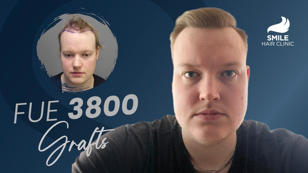 Hair Transplant - Before & After : 3800 Grafts Transformation | 9-Month Result