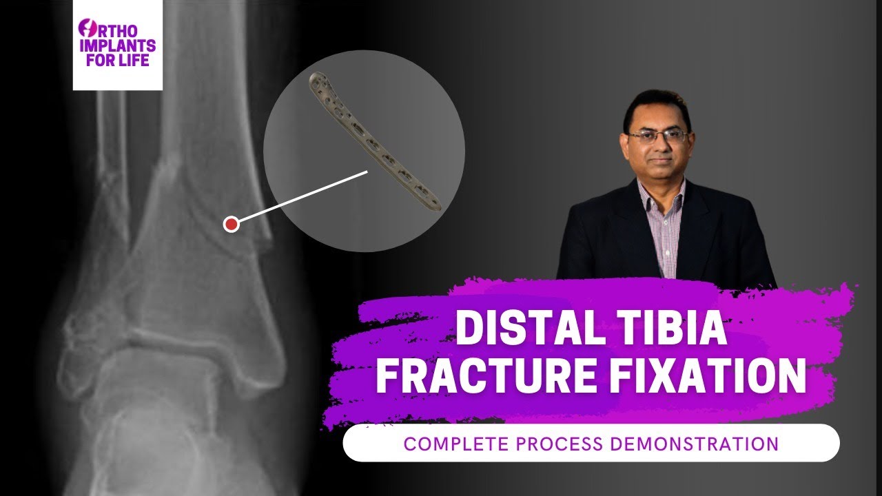 Distal Tibia Fracture | Distal Tibia Medial Locking Plate