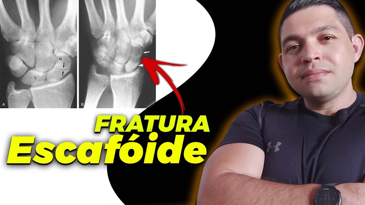 Exercícios para Fratura do Escafoide