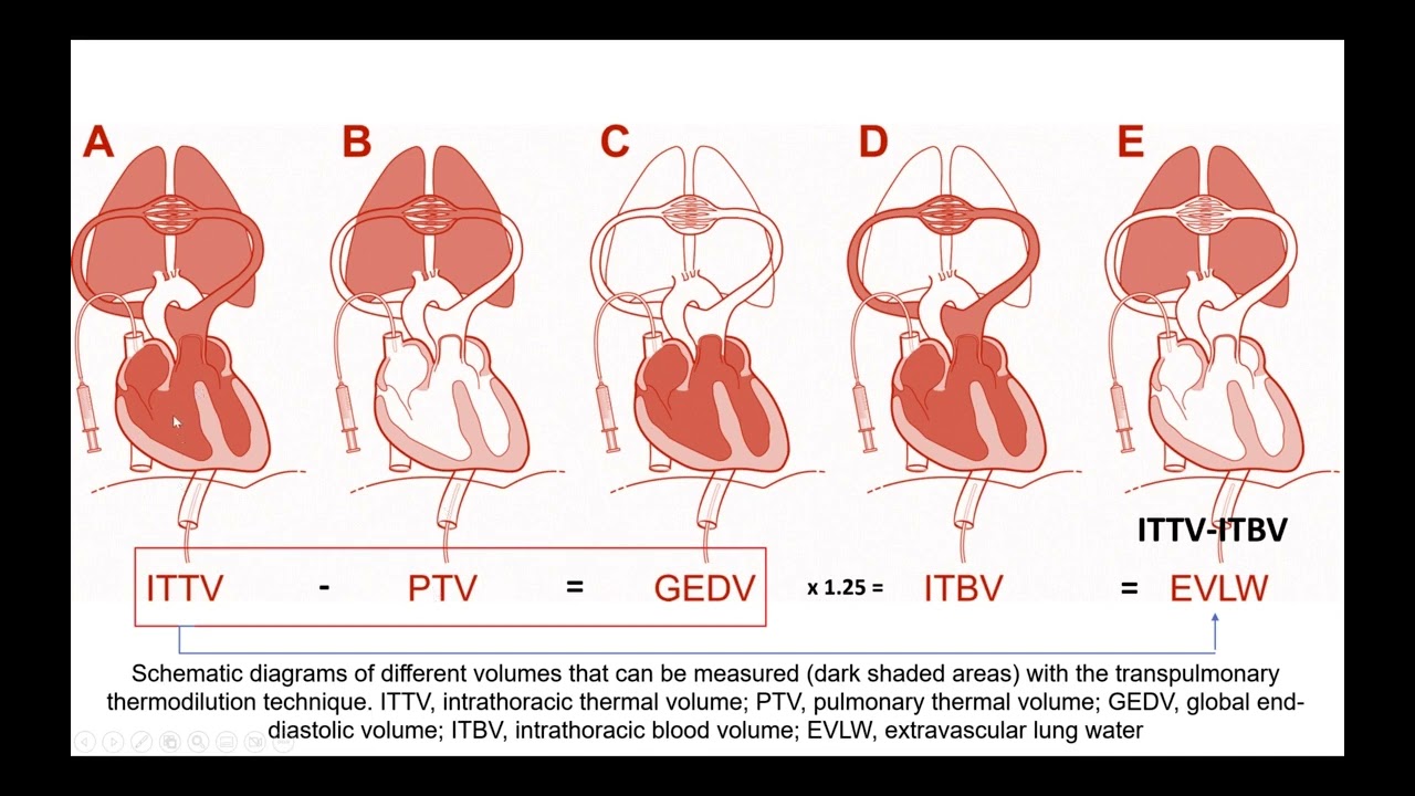 Transpulmonary Thermodilution method: Case studies