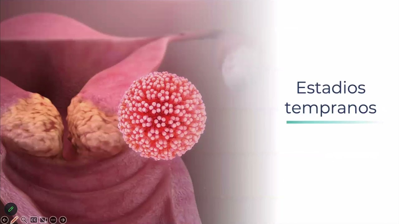 Manejo Actual del Cáncer Cervicouterino, Dra. Karla Castrejón Téllez