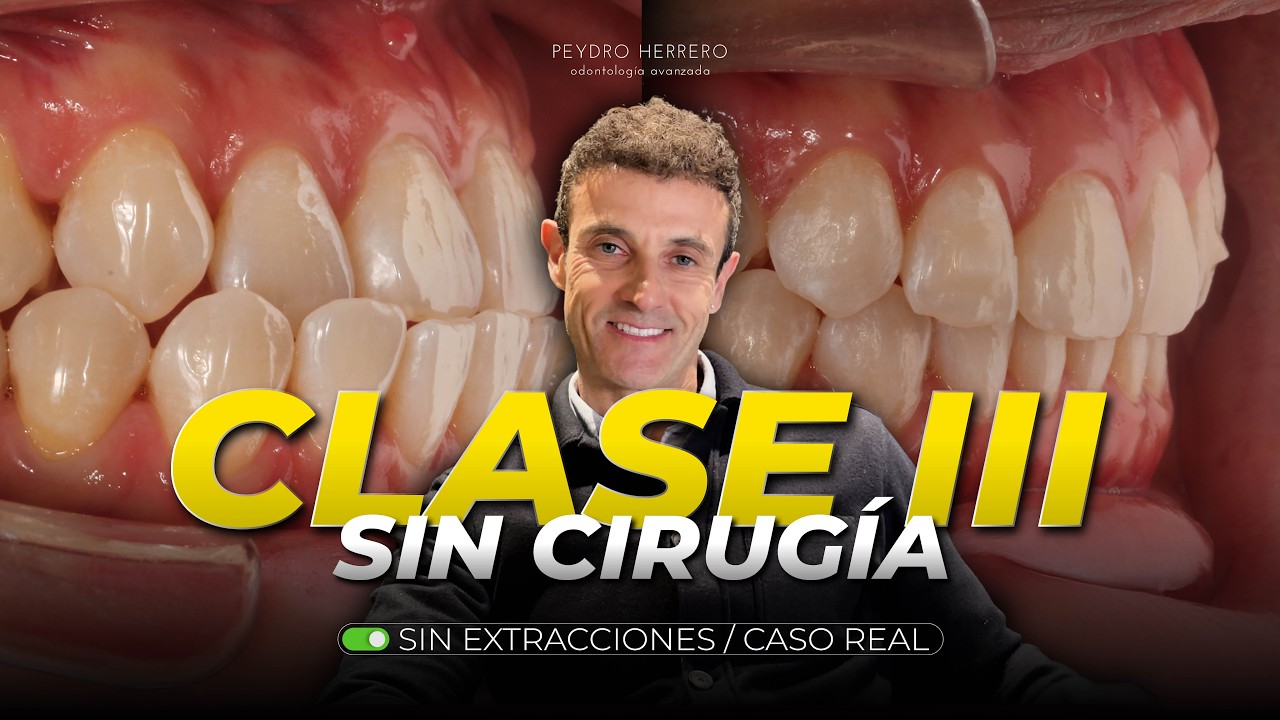 Clase III: Cómo Evitamos Cirugía Ortognática y Extracciones con Ortodoncia Invisible (Caso Real)