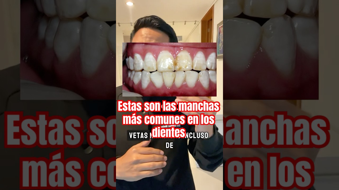 Estas son las manchas m&aacute;s comunes en los dientes, y aqu&iacute; te digo que son 🦷😥