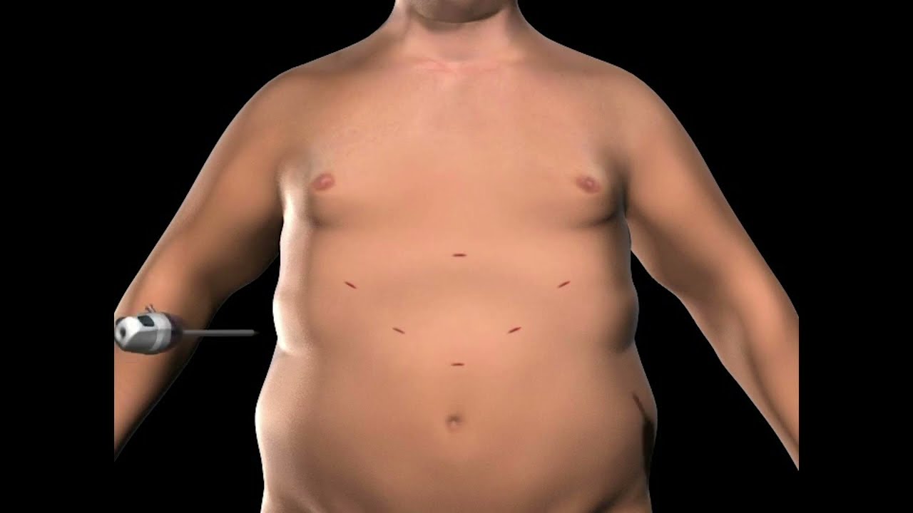 Legacy Weight Loss Surgery Welcome Group
