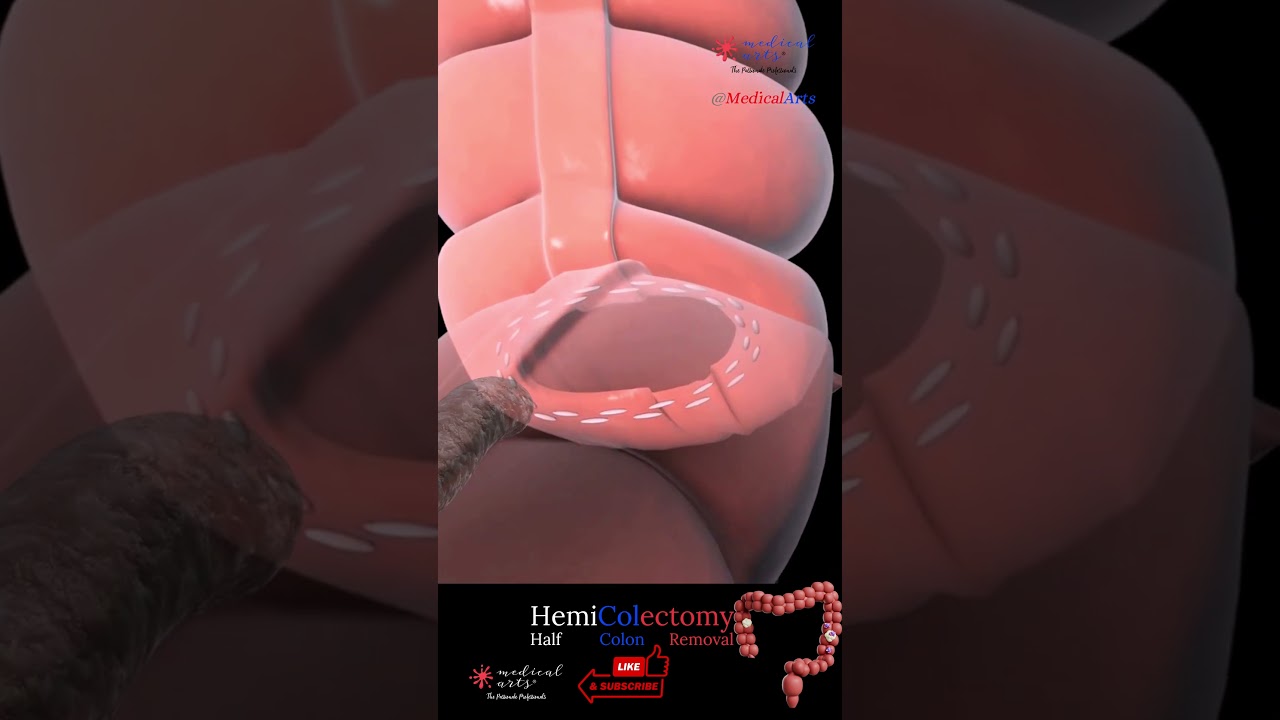 hemicolectomy surgery medical arts
