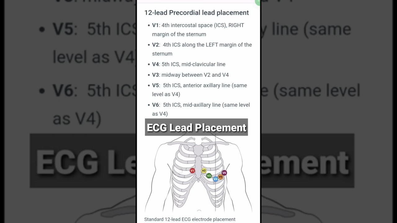 ECG Lead Placement Correct Position