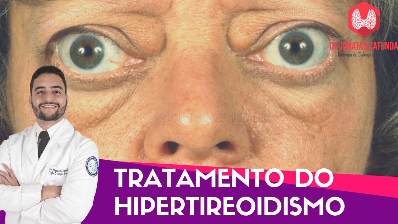 Tratamento do Hipertireoidismo