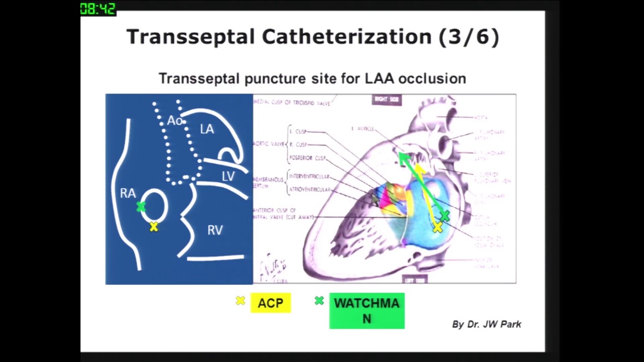 Targeted septal puncture technique