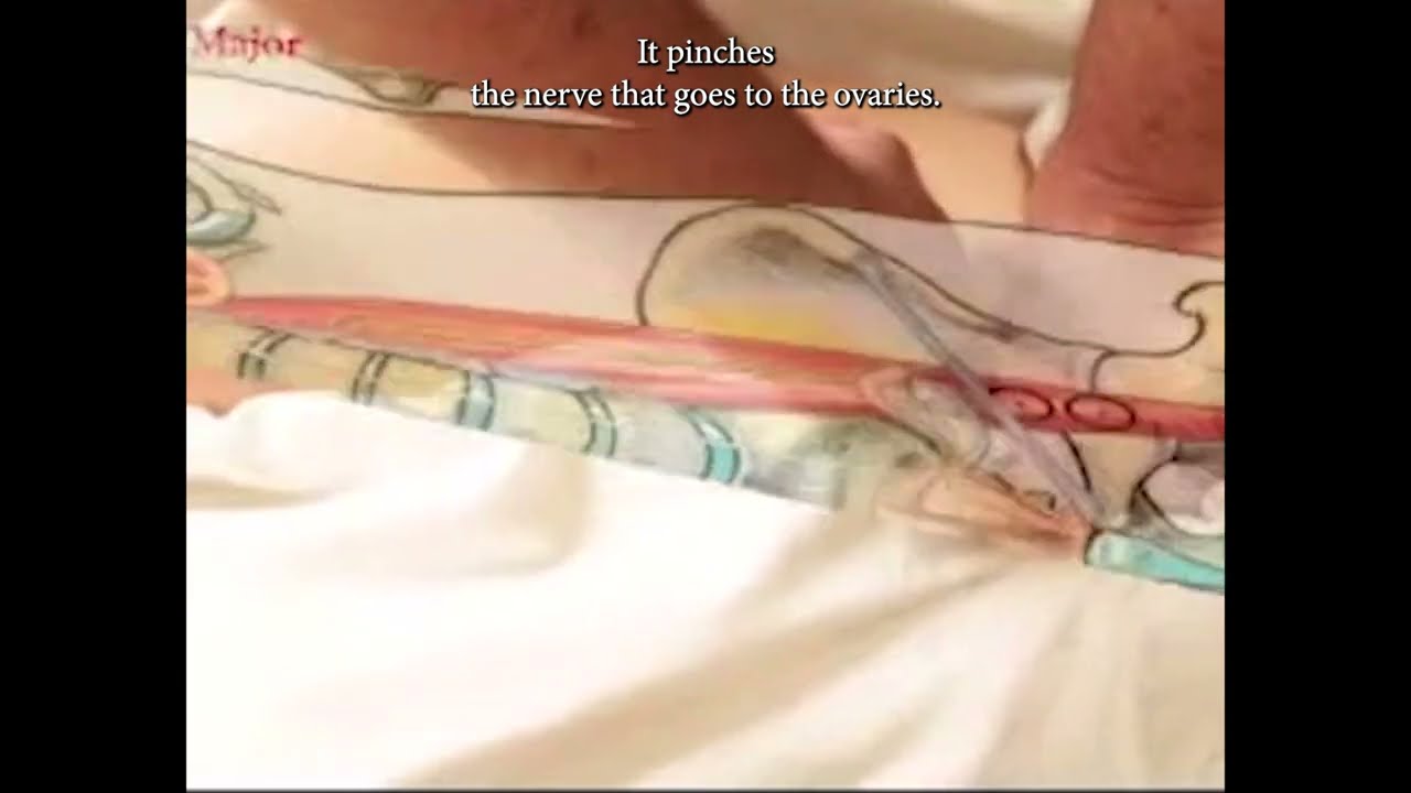 Low back and infertility