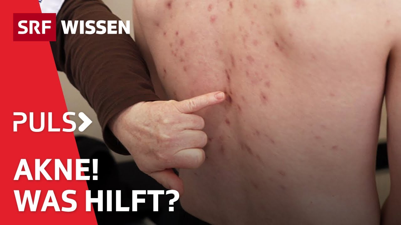 Pickelalarm – Wie werde ich Akne wieder los? Konkrete Tipps und Ratschläge | Puls | SRF Wissen
