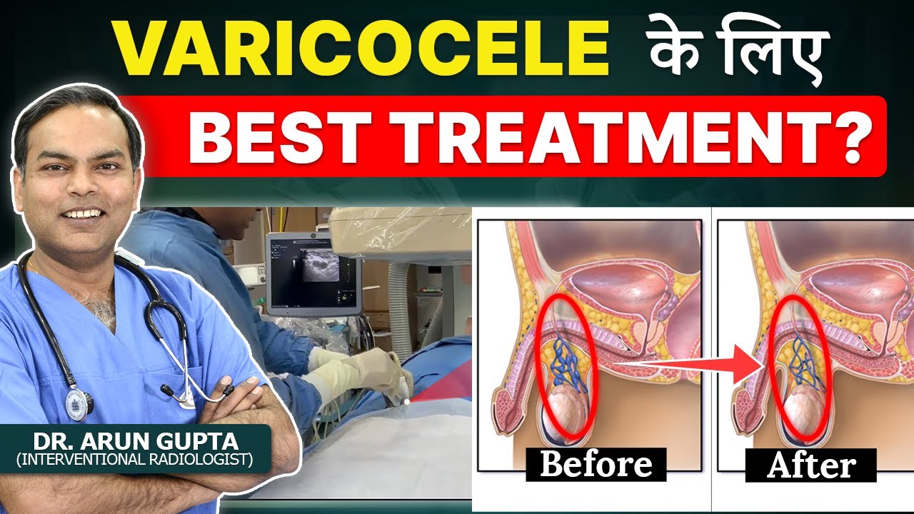 Varicocele से जुड़े सभी Myths और FAQs और क्यों Non-Surgical Treatment सबसे बेहतर विकल्प है