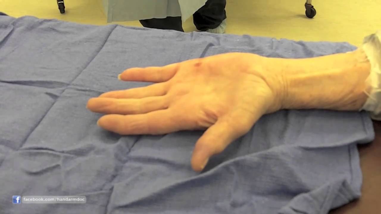 What Are The Trigger Finger Symptoms?