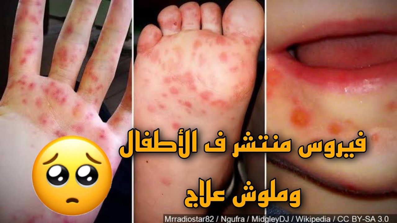 خمسة لطفلك l متلازمة الفم والايدي والقدم .. مرض منتشر في الاطفال، وملوش علاج 🥺