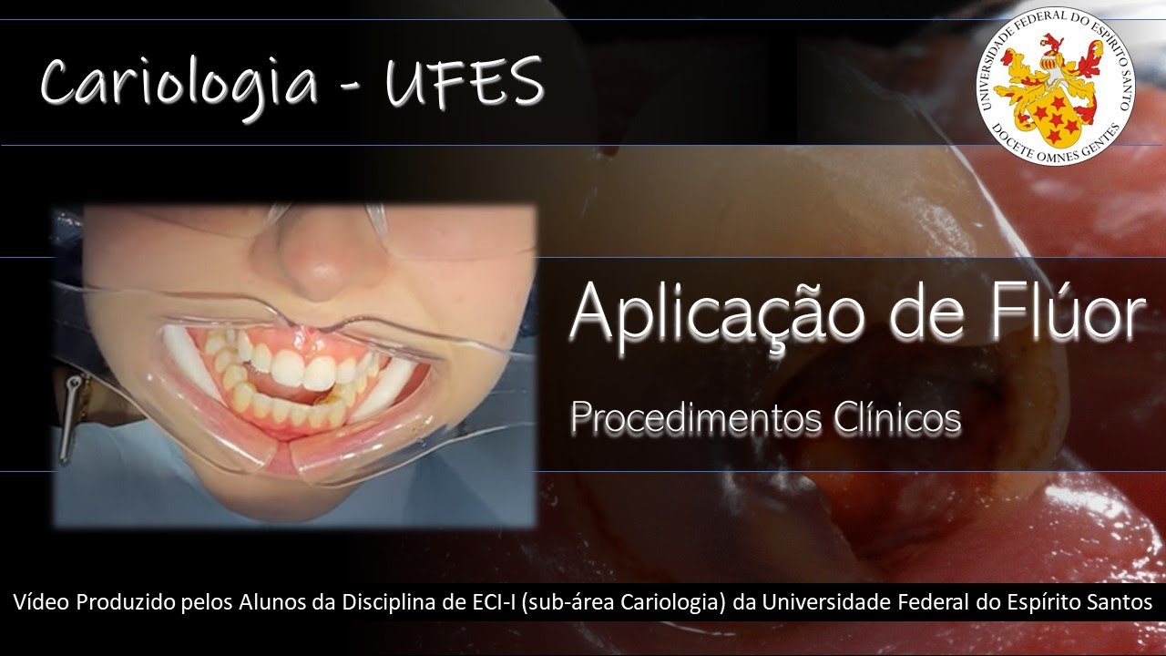 Como é Feita a APLICAÇÃO TÓPICA de FLÚOR pelo Dentista?