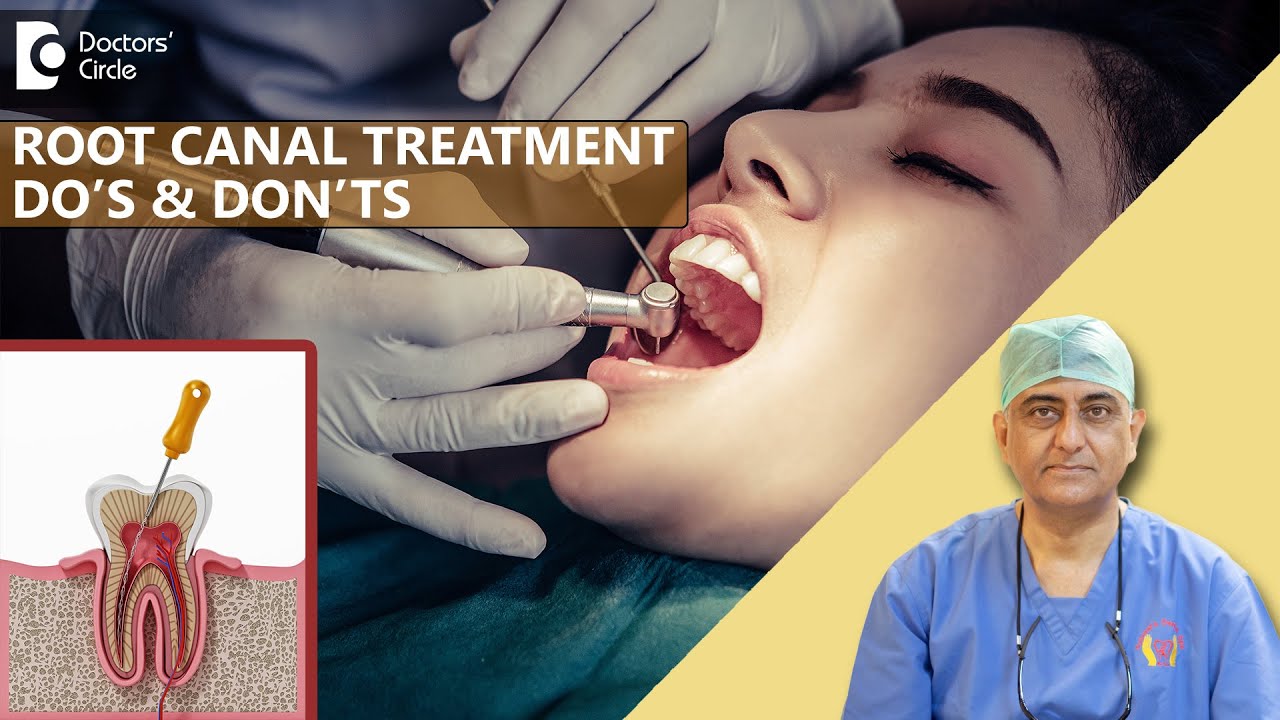 Dos and Don&rsquo;ts before & after a Root Canal Treatment - Dr. Manesh Chandra Sharma| Doctors' Circle
