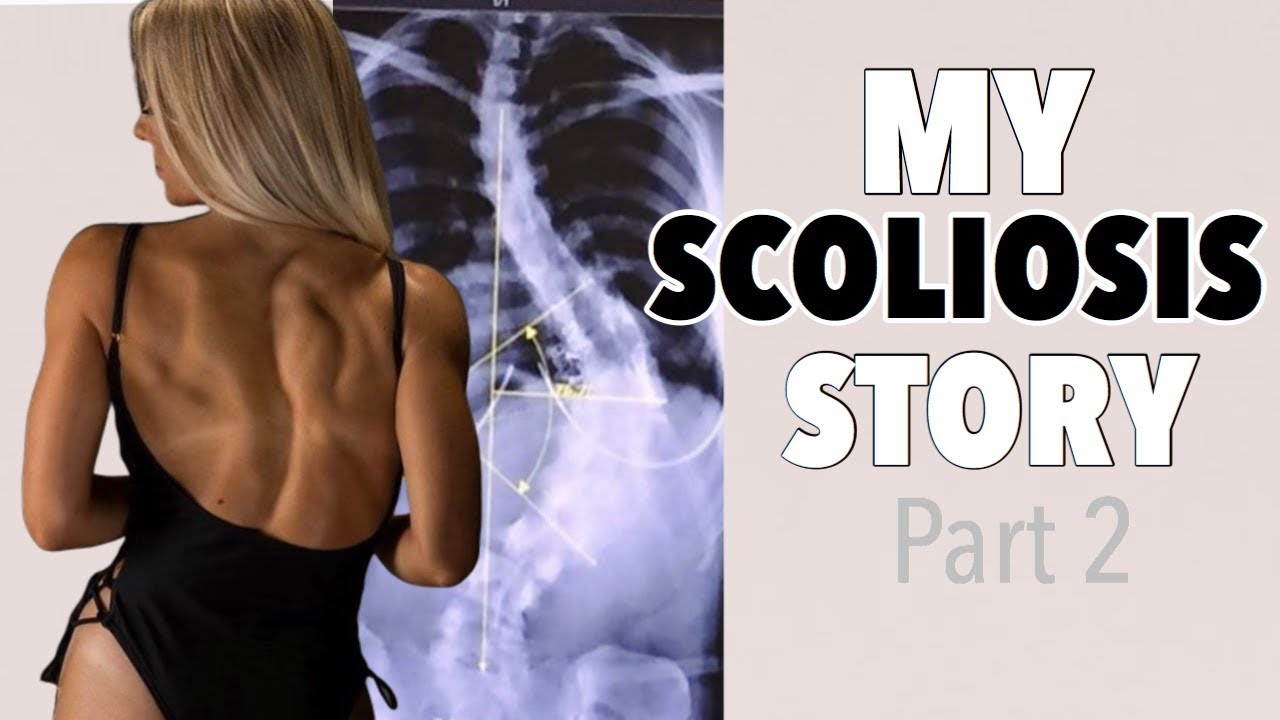 MY SCOLIOSIS STORY //  PART 2