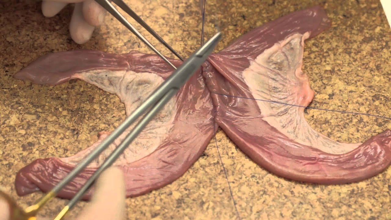 Side to side bowel anastomosis (simulated)