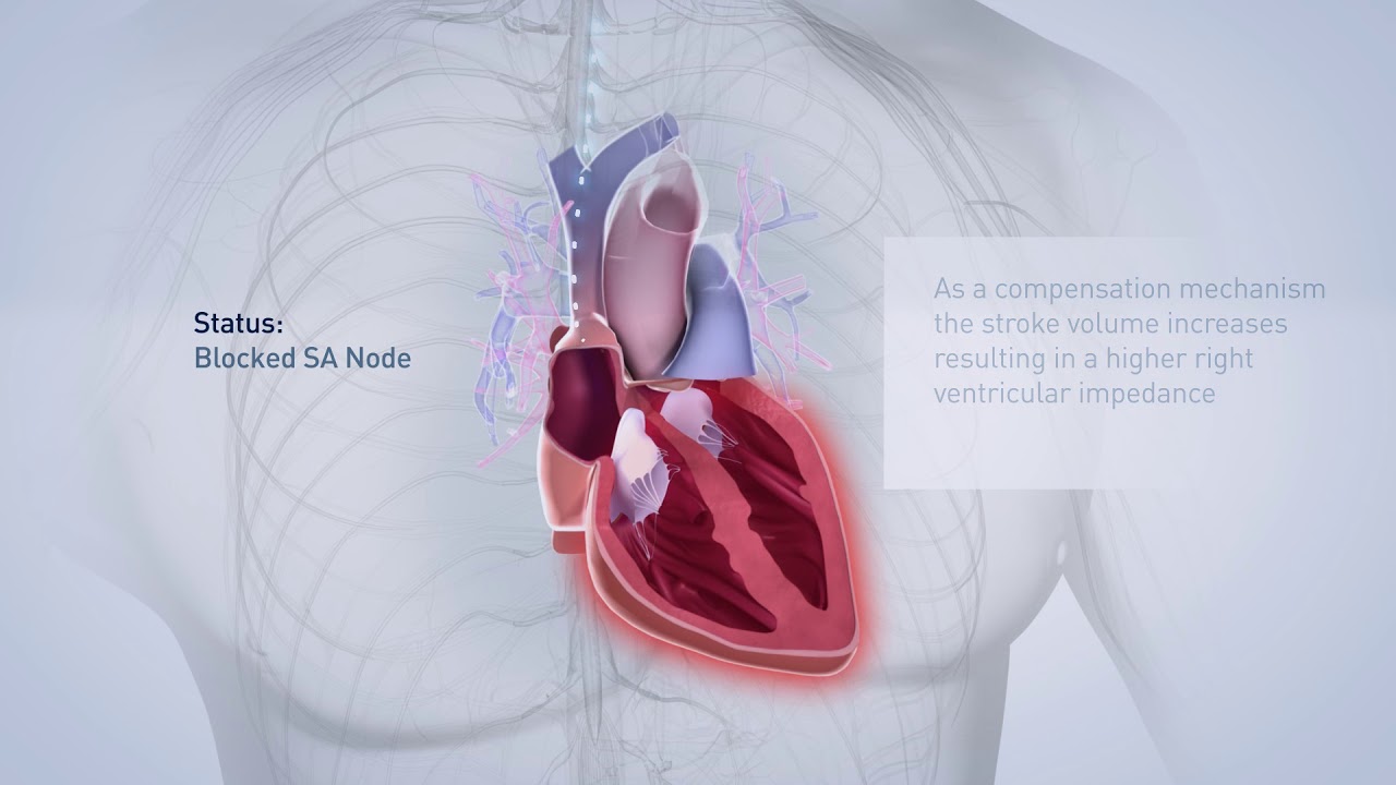 Biotronik pacemaker