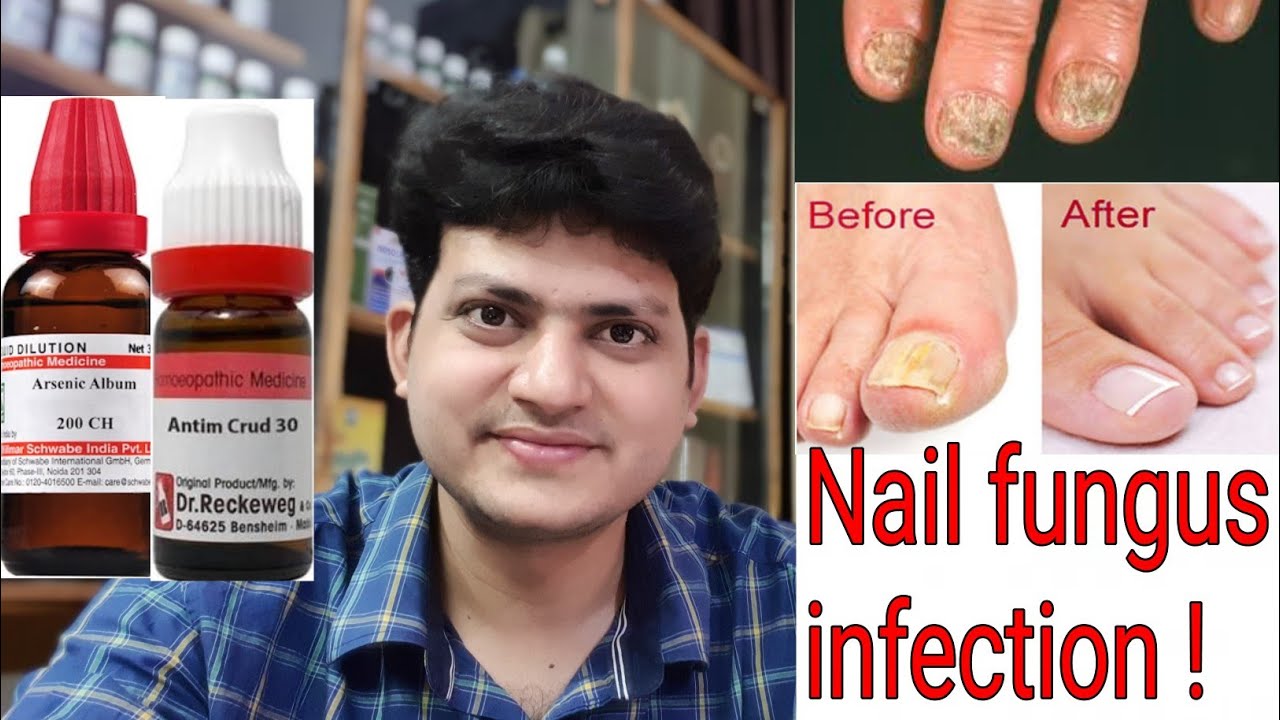 Nail fungus ! Homeopathic Medicine  for Nail fungus infection ? Explain