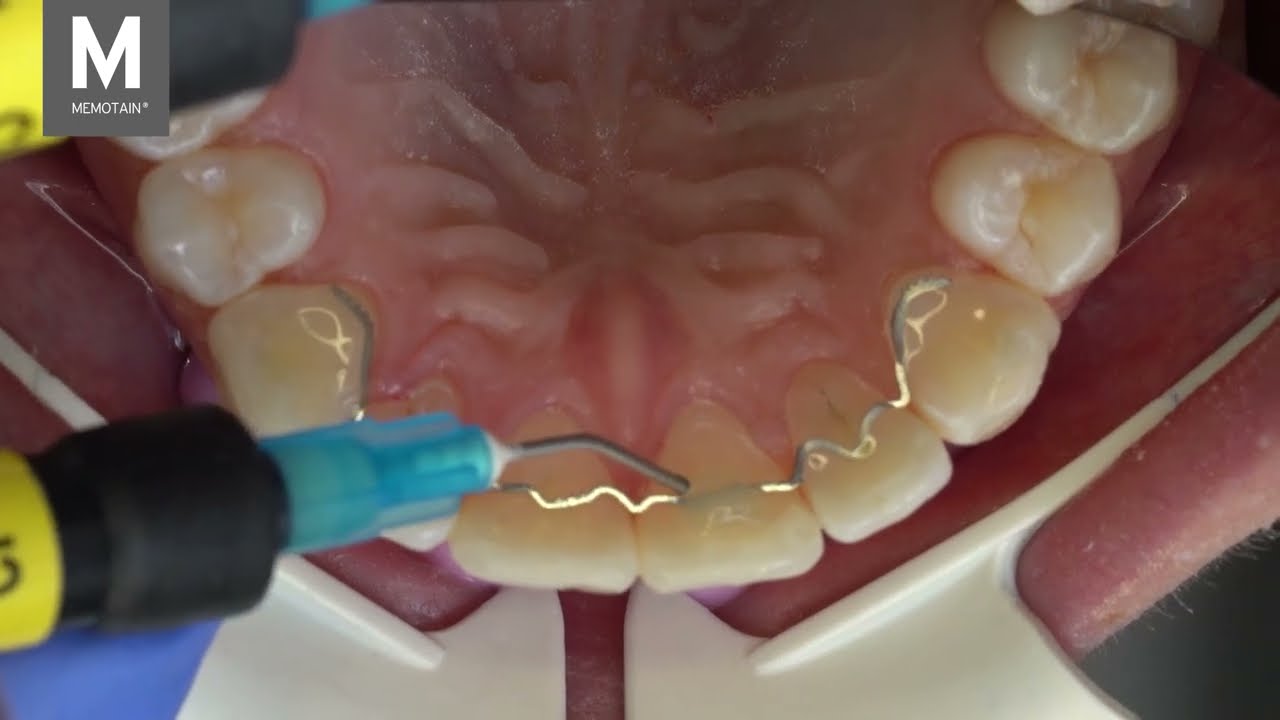 Klinischer Klebefilm SCHEU MEMOTAIN® - Dr. Pascal Schumacher