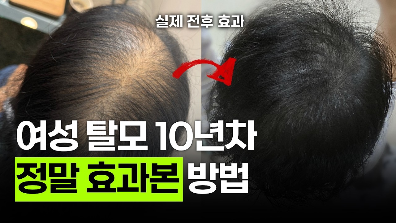 의사도 거절한 여자 정수리탈모 극복후기, 10년동안 해보고 진짜 효과본 방법