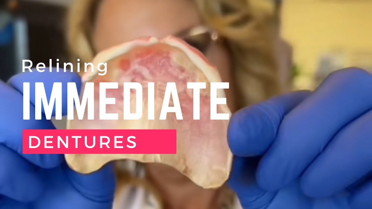 Converting Immediate Denture to Permanent Denture by permanent Reline procedure