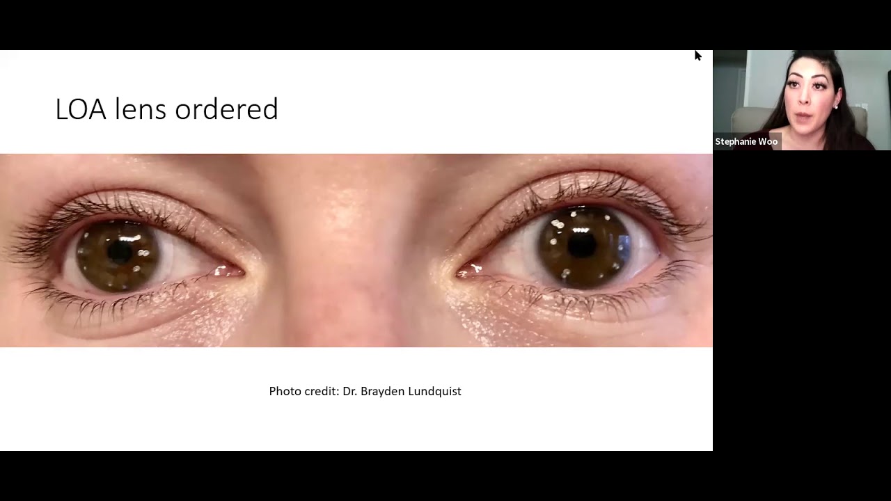 Higher Order Aberration Scleral Lens Case Report