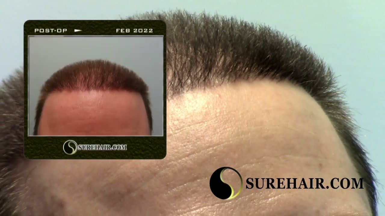 5 Months of Growth ~ FUE 2500 Grafts
