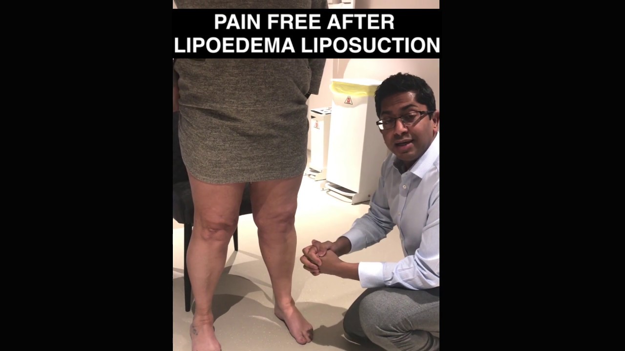 Lipoedema: Pain free after lipoedema liposuction
