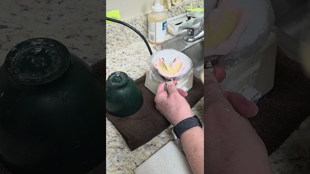 Pouring a lower dental impression in stone
