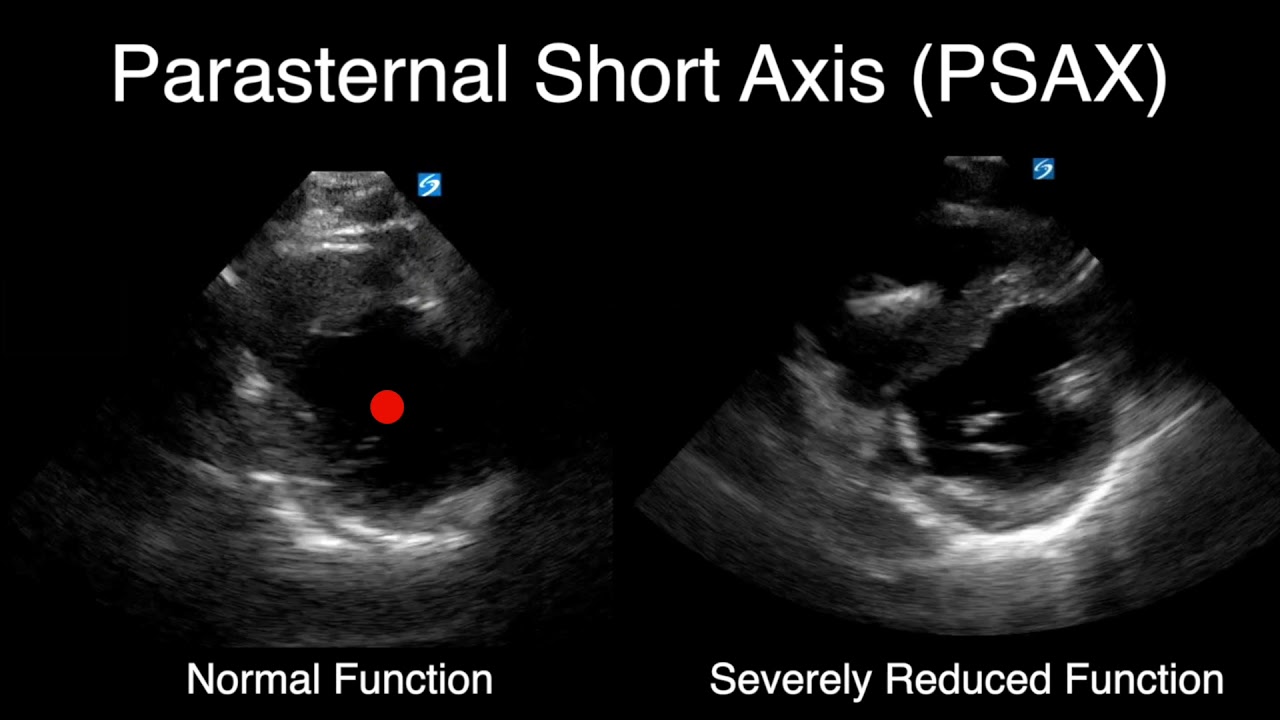 POCUS — визуальная оценка функции сердца
