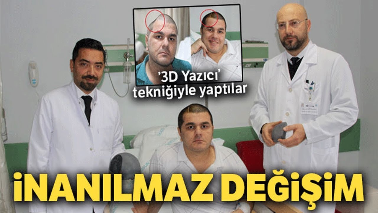 ’3D Yazıcı’ Tekniğiyle Kafasına Titanyum Parça Takılan Hastanın İnanılmaz Değişimi