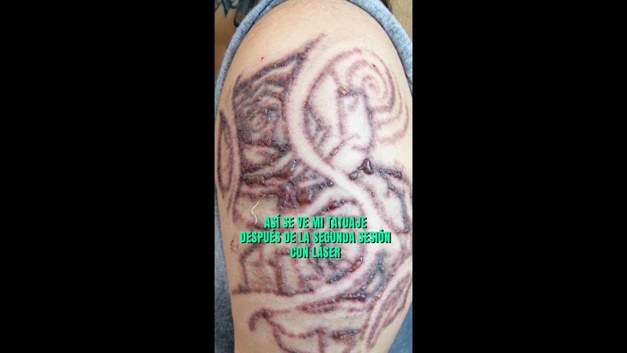 Resultado segunda sesión para ELIMINAR mi TATUAJE con láser 🔥