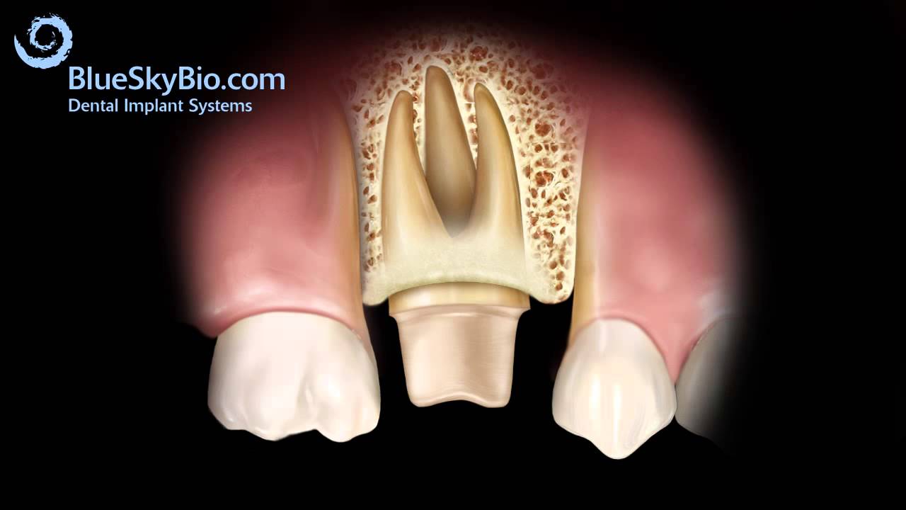 Patient Treatment Videos: Crown Lengthening