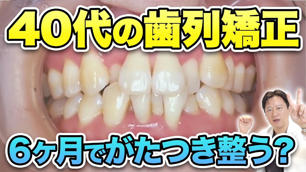 【歯列矯正】40代・50代でも6ヶ月で歯並びは整う？ガチャ歯でEライン抜歯矯正と期間の真実【審美歯科 歯並び】