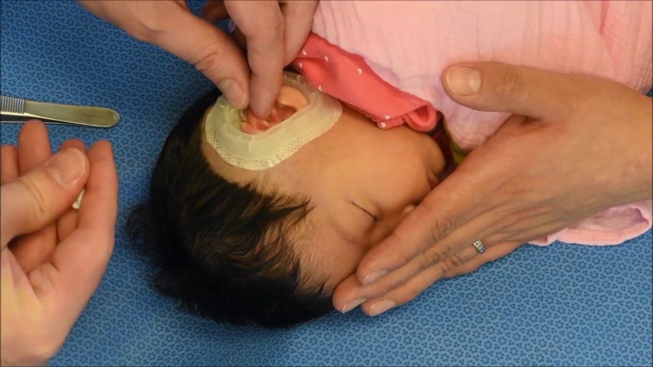 Placing the EarWell™ Infant Ear Correction System - Dr. Eric Payne