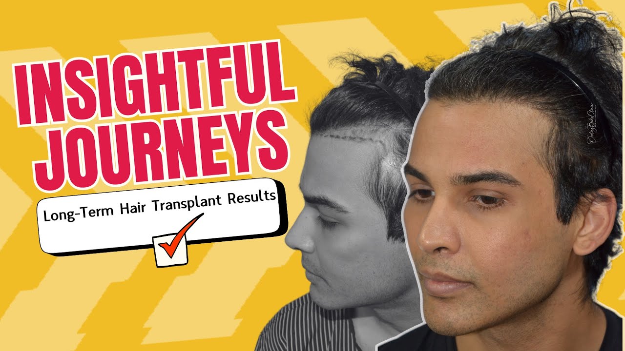 Hair Transplant in India | A hair transplant result 7 years after