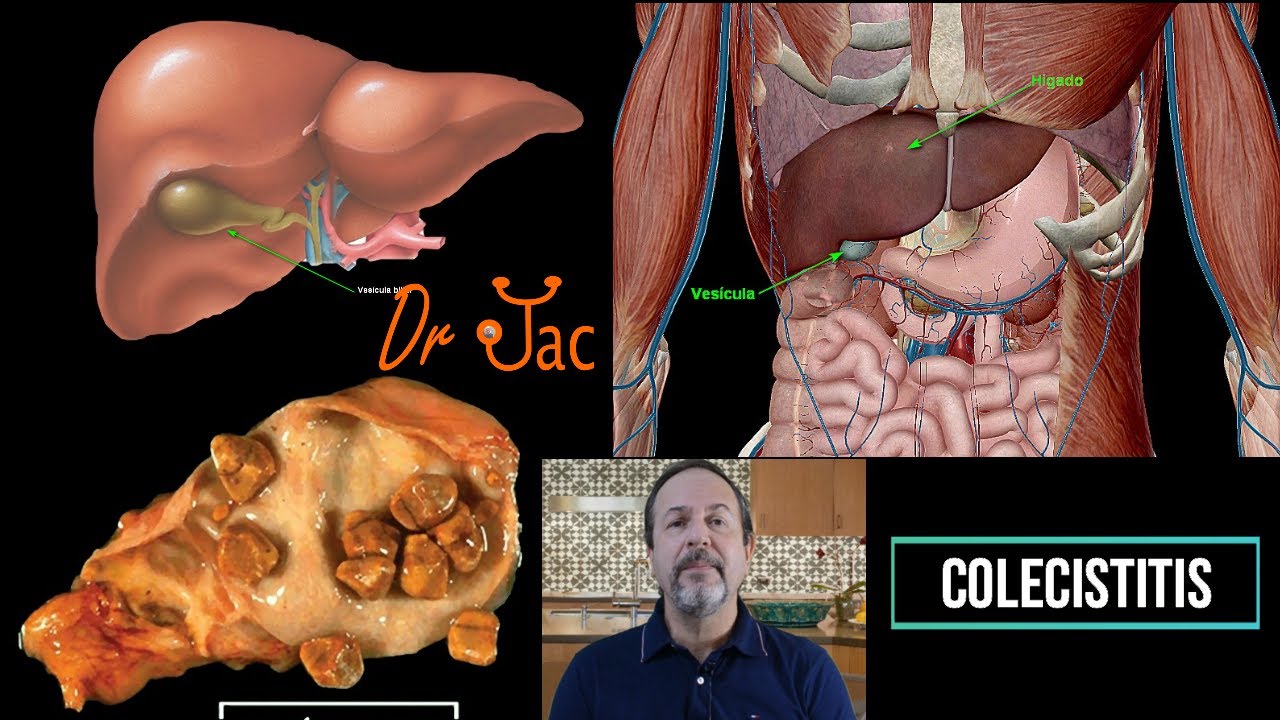 Colecistitis